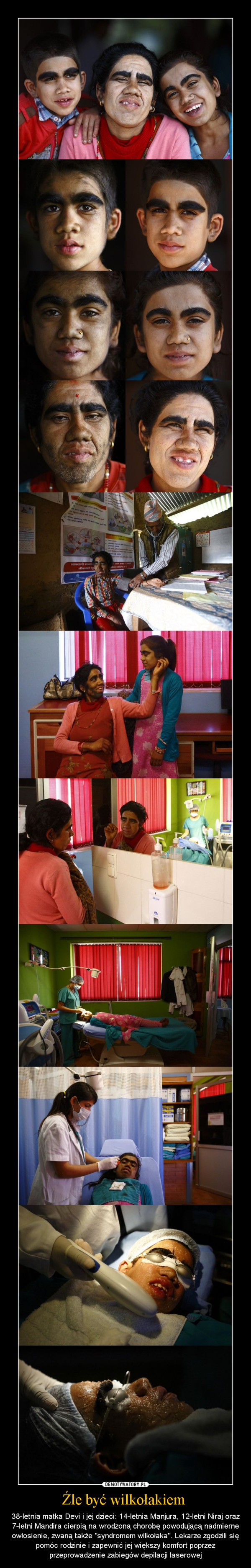 Źle być wilkołakiem  – 38-letnia matka Devi i jej dzieci: 14-letnia Manjura, 12-letni Niraj oraz 7-letni Mandira cierpią na wrodzoną chorobę powodującą nadmierne owłosienie, zwaną także "syndromem wilkołaka". Lekarze zgodzili się pomóc rodzinie i zapewnić jej większy komfort poprzez przeprowadzenie zabiegów depilacji laserowej 