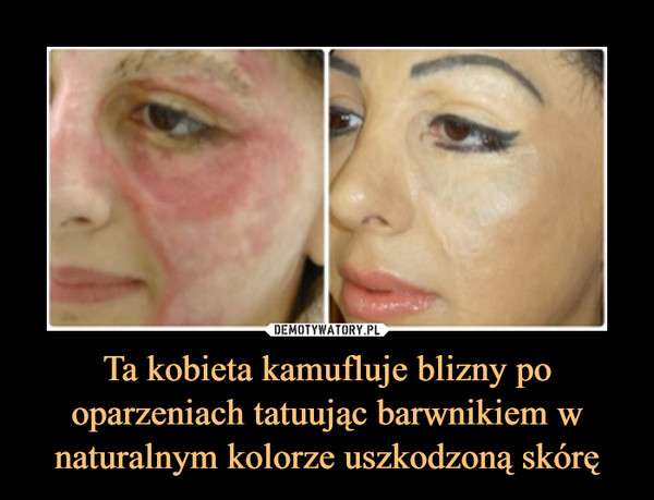 Ta kobieta kamufluje blizny po oparzeniach tatuując barwnikiem w naturalnym kolorze uszkodzoną skórę –  