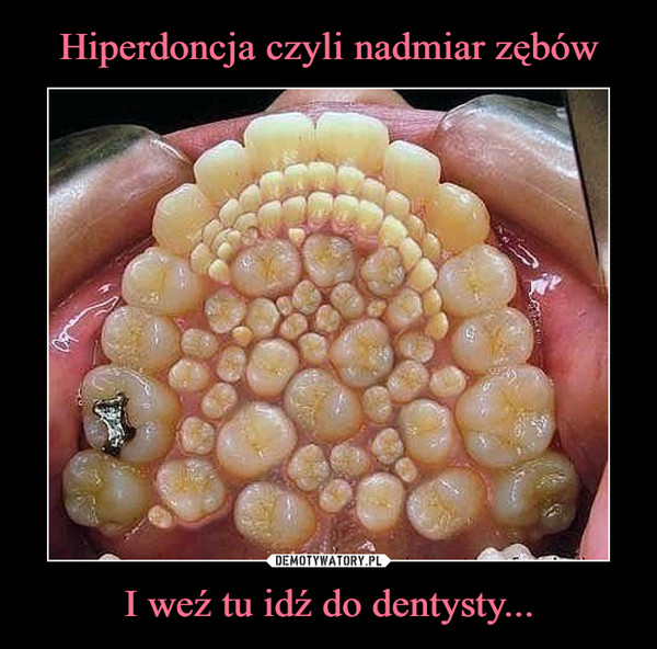 Hiperdoncja czyli nadmiar zębów I weź tu idź do dentysty...