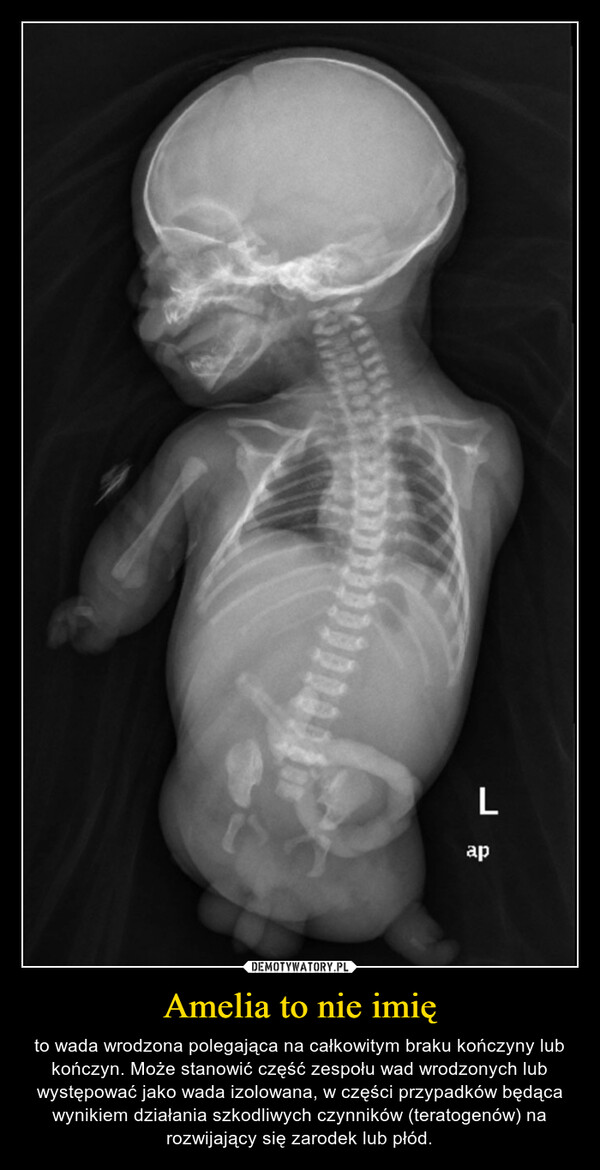 Amelia to nie imię – to wada wrodzona polegająca na całkowitym braku kończyny lub kończyn. Może stanowić część zespołu wad wrodzonych lub występować jako wada izolowana, w części przypadków będąca wynikiem działania szkodliwych czynników (teratogenów) na rozwijający się zarodek lub płód. 