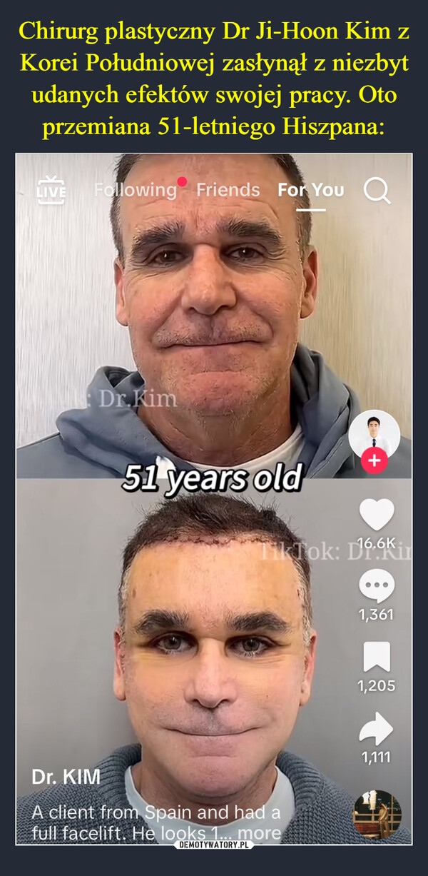  –  LIVE Following Friends For You QDr.Kim51 years oldTikTok: 116.6KDr. KIMA client from Spain and had afull facelift. He looks 1... more1,3611,2051,111